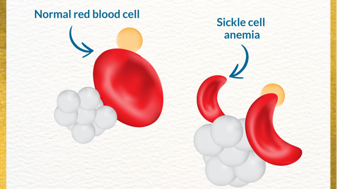 sickle cell anaemia