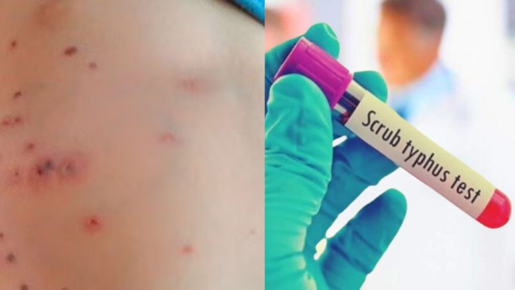 Patients of scrub typhus i.e. mysterious fever are also being reported in Vindhya and Rewa.