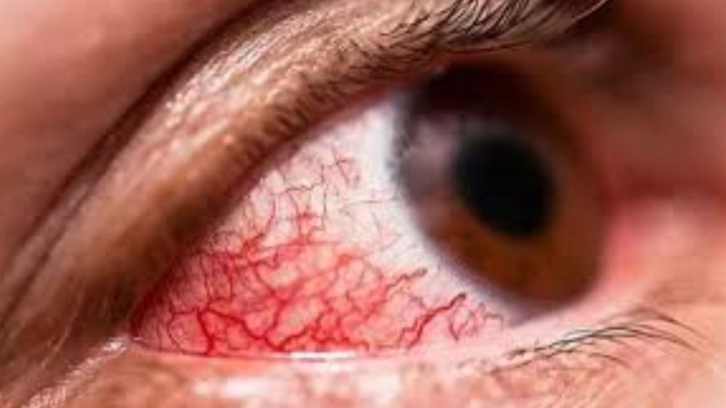 Bleeding Eye Virus