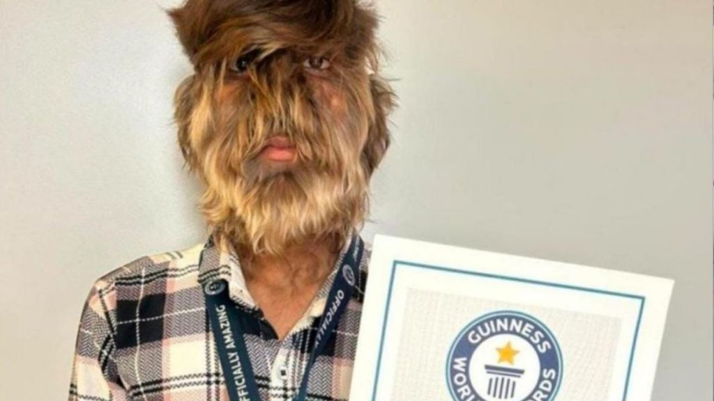 Ratlam: Lalit's name entered in Guinness Book of Records for having long hair on his face