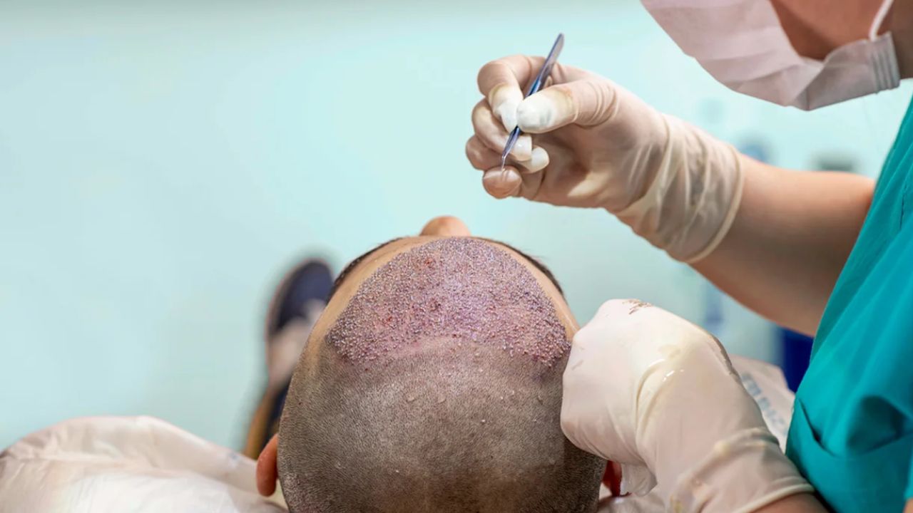 Hair Transplant