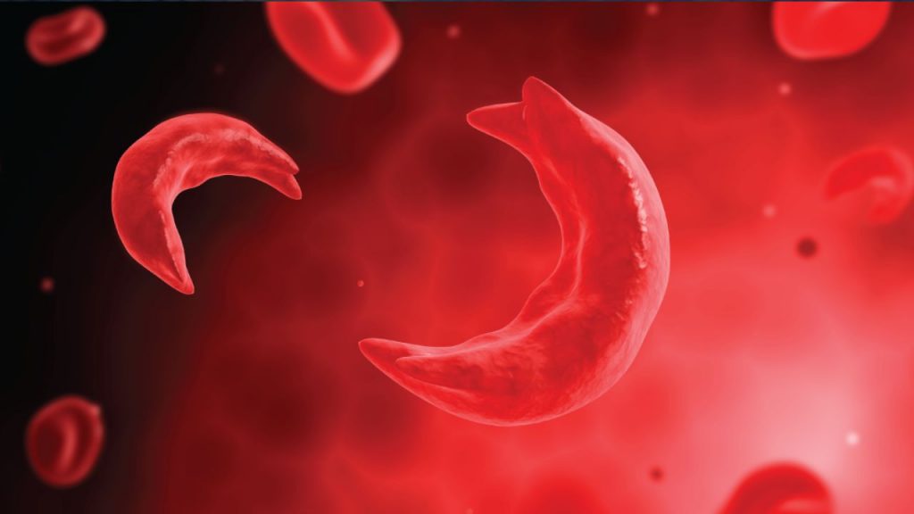 Sickle Cell Anemia