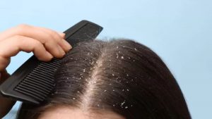 Winter dandruff remedies and scalp treatment tips