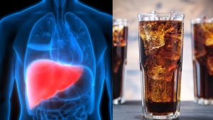 Fatty Liver Turned Cirrhosis