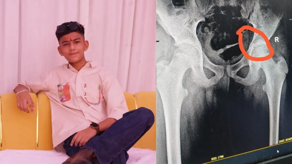 njection needle gets stuck in teenager's hip in Dewas.