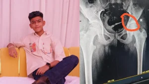 njection needle gets stuck in teenager's hip in Dewas.