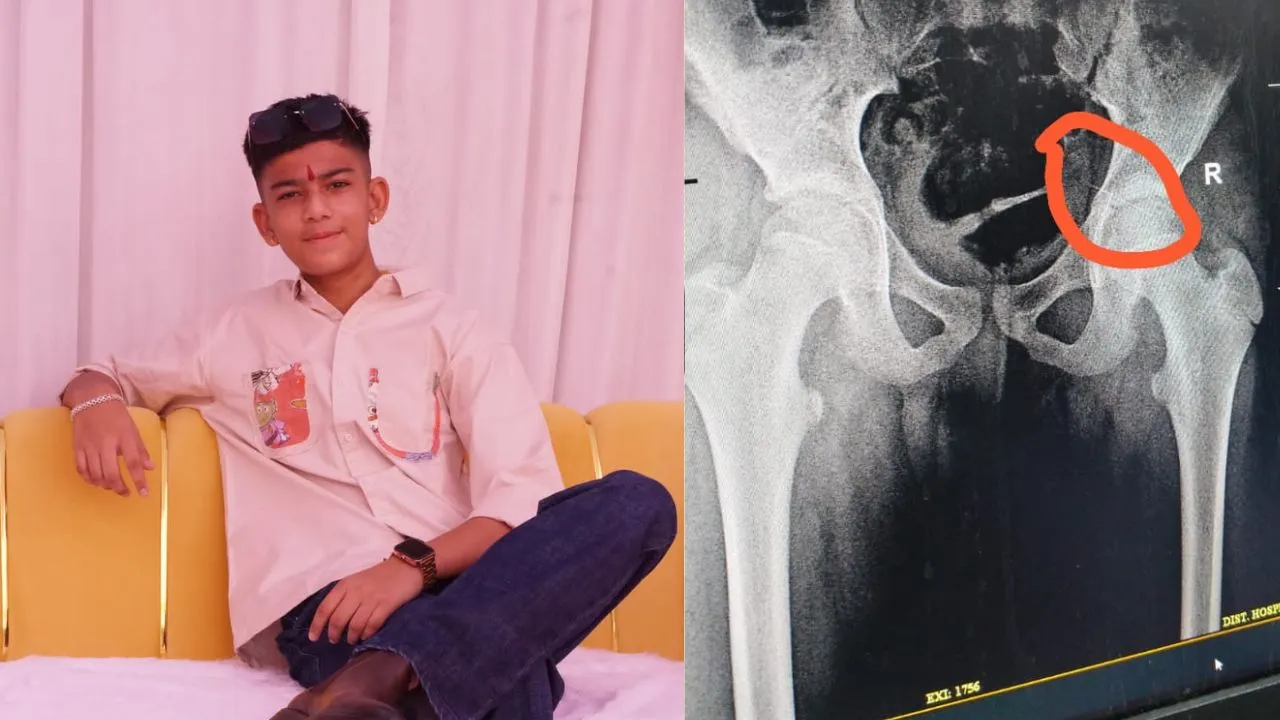 njection needle gets stuck in teenager's hip in Dewas.