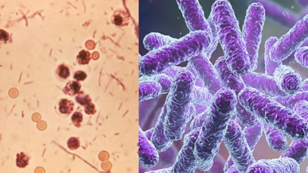 shigella infection