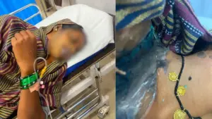 Durg Acid attack